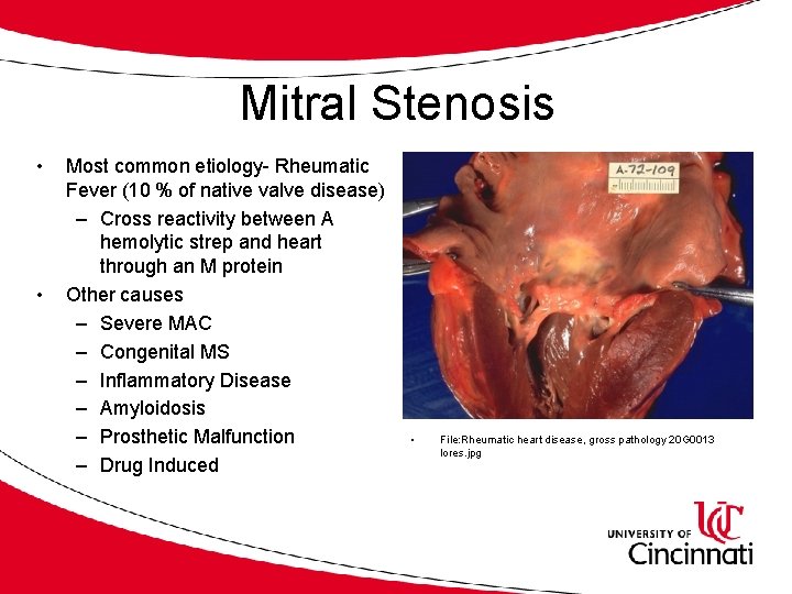Mitral Stenosis • • Most common etiology- Rheumatic Fever (10 % of native valve