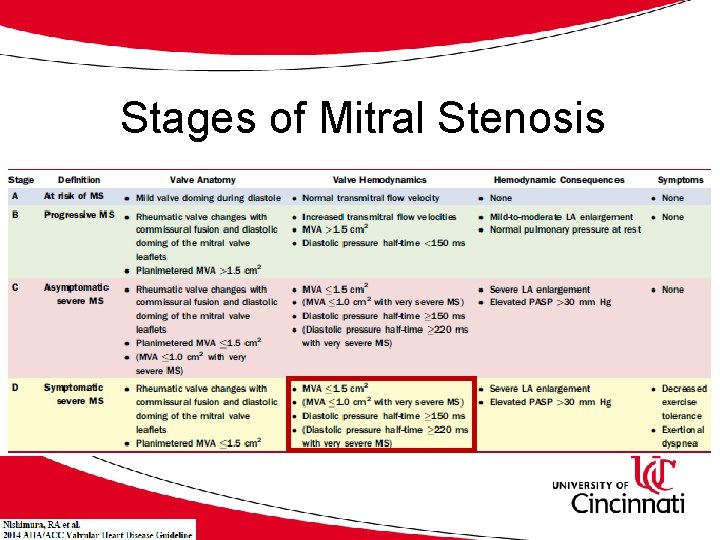Stages of Mitral Stenosis 