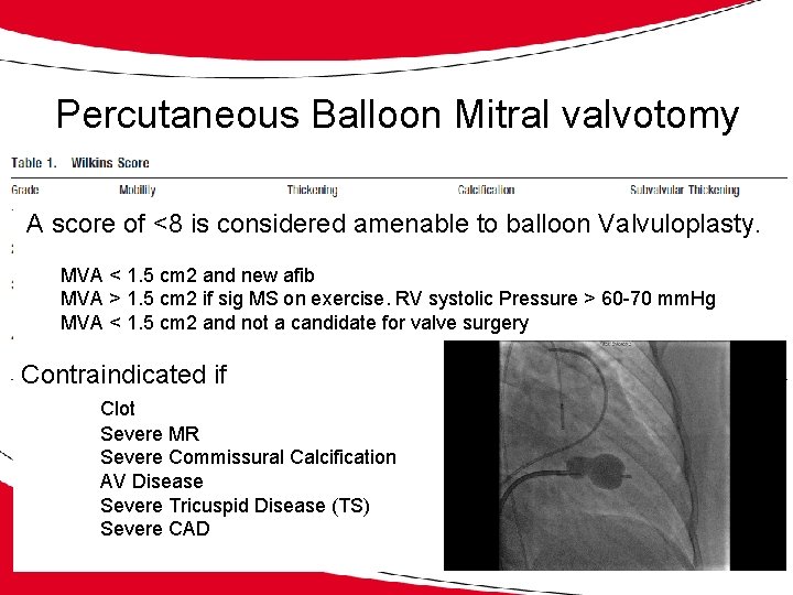 Percutaneous Balloon Mitral valvotomy A score of <8 is considered amenable to balloon Valvuloplasty.