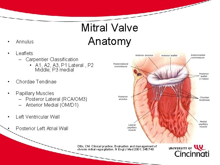 Mitral Valve Anatomy • Annulus • Leaflets – Carpentier Classification • A 1, A