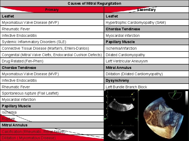 Causes of Mitral Regurgitation Primary Secondary Leaflet Myxomatous Valve Disease (MVP) Hypertrophic Cardiomyopathy (SAM)