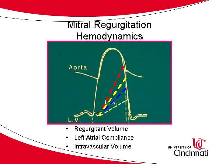 Mitral Regurgitation Hemodynamics • Regurgitant Volume • Left Atrial Compliance • Intravascular Volume 