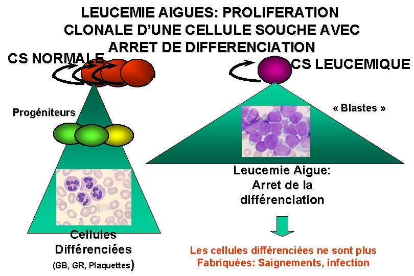 LEUCEMIE AIGUES: PROLIFERATION CLONALE D’UNE CELLULE SOUCHE AVEC ARRET DE DIFFERENCIATION CS NORMALE CS