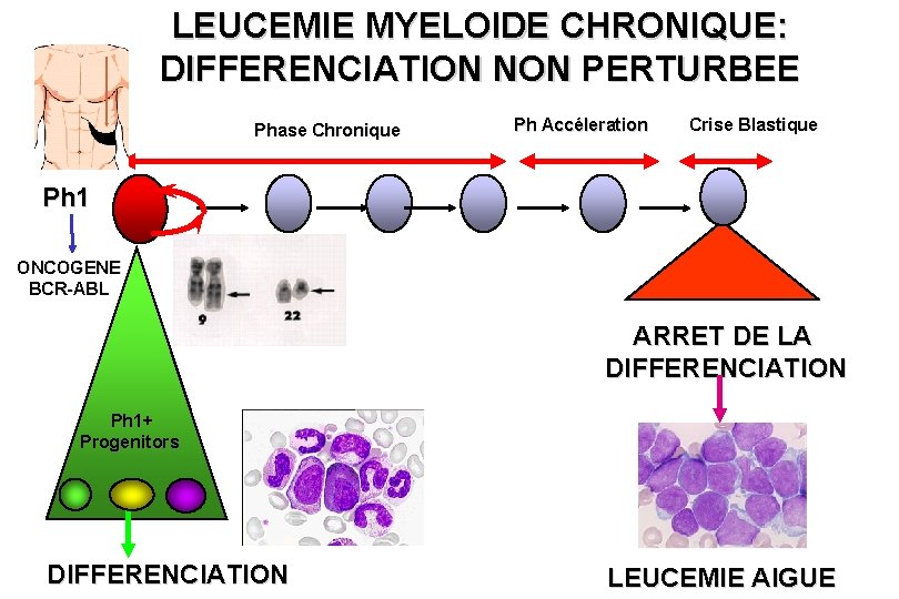 LEUCEMIE MYELOIDE CHRONIQUE: DIFFERENCIATION NON PERTURBEE Phase Chronique Ph Accéleration Crise Blastique Ph 1