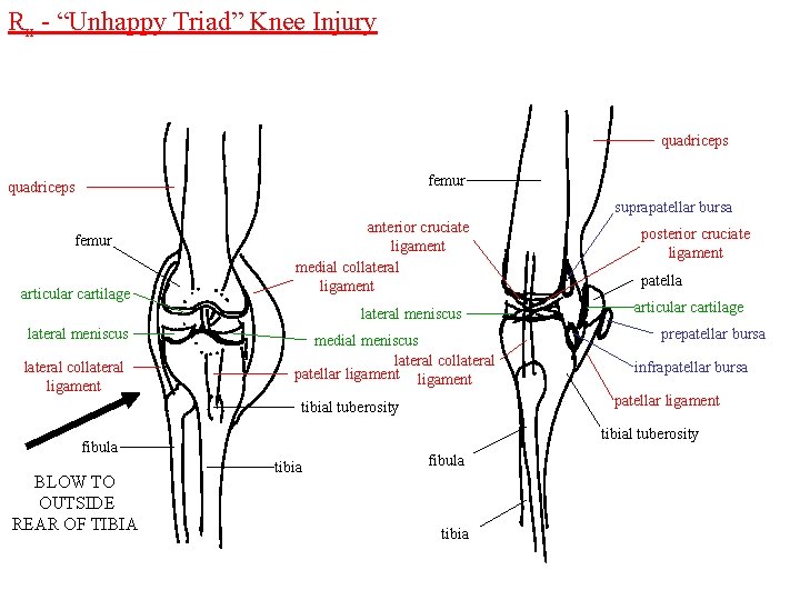 Rx - “Unhappy Triad” Knee Injury quadriceps femur quadriceps suprapatellar bursa femur articular cartilage