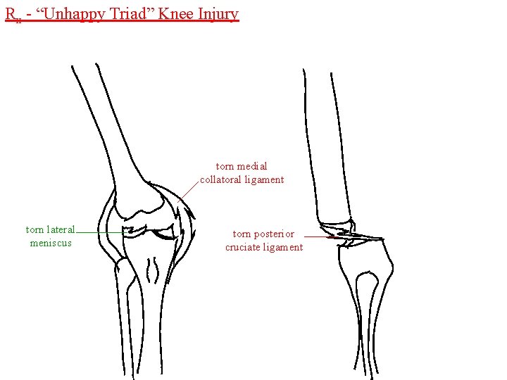 Rx - “Unhappy Triad” Knee Injury torn medial collatoral ligament torn lateral meniscus torn