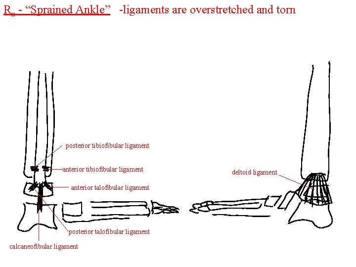 Rx - “Sprained Ankle” -ligaments are overstretched and torn posterior tibiofibular ligament anterior talofibular