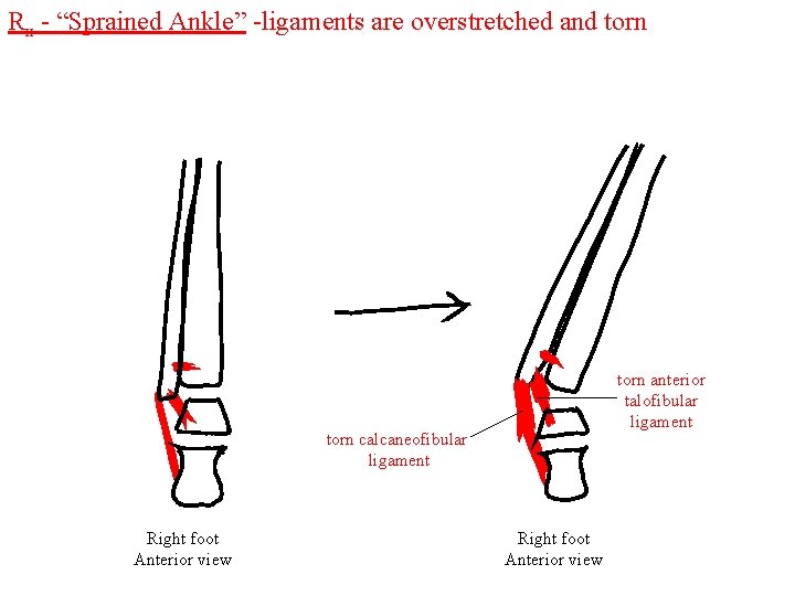 Rx - “Sprained Ankle” -ligaments are overstretched and torn anterior talofibular ligament torn calcaneofibular