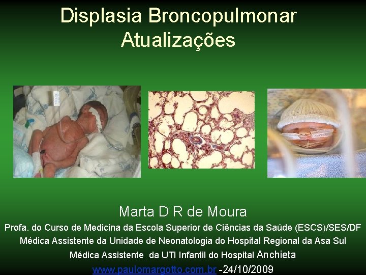 Displasia Broncopulmonar Atualizações Marta D R de Moura Profa. do Curso de Medicina da