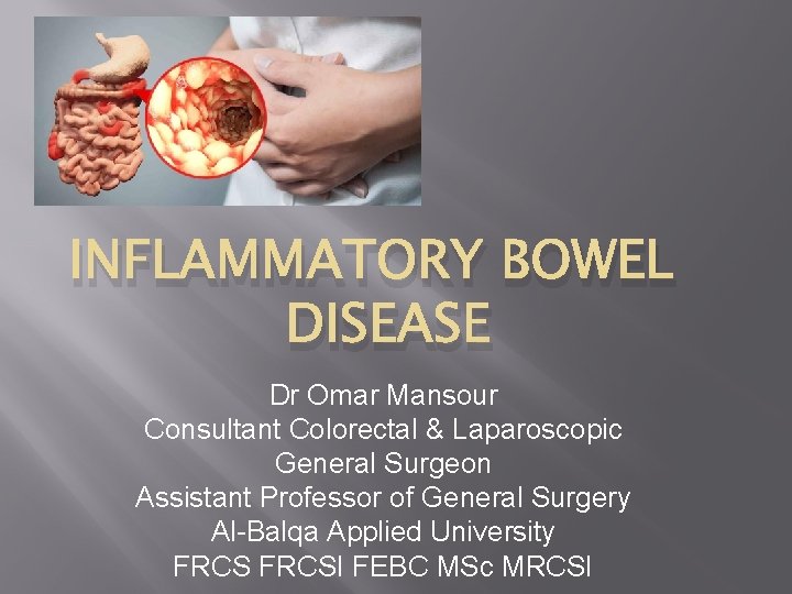 INFLAMMATORY BOWEL DISEASE Dr Omar Mansour Consultant Colorectal & Laparoscopic General Surgeon Assistant Professor