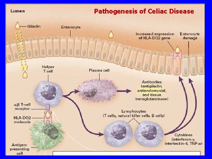 Pathogenesis of Celiac Disease 