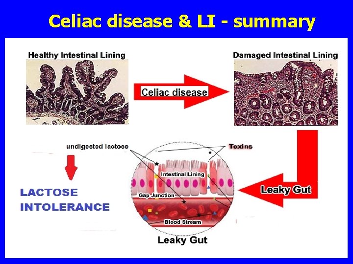 Celiac disease & LI - summary 