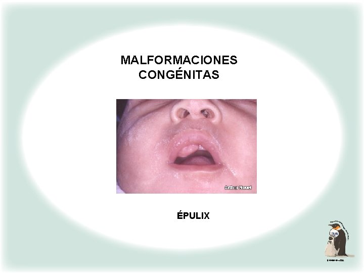 MALFORMACIONES CONGÉNITAS ÉPULIX 