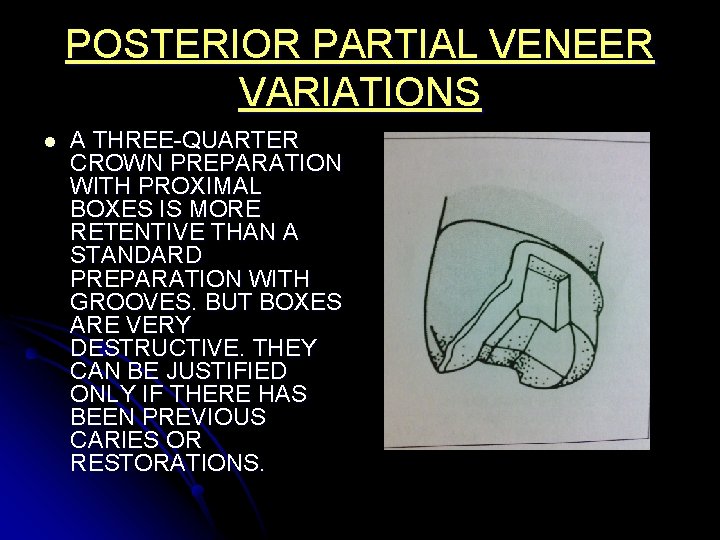 POSTERIOR PARTIAL VENEER VARIATIONS l A THREE-QUARTER CROWN PREPARATION WITH PROXIMAL BOXES IS MORE