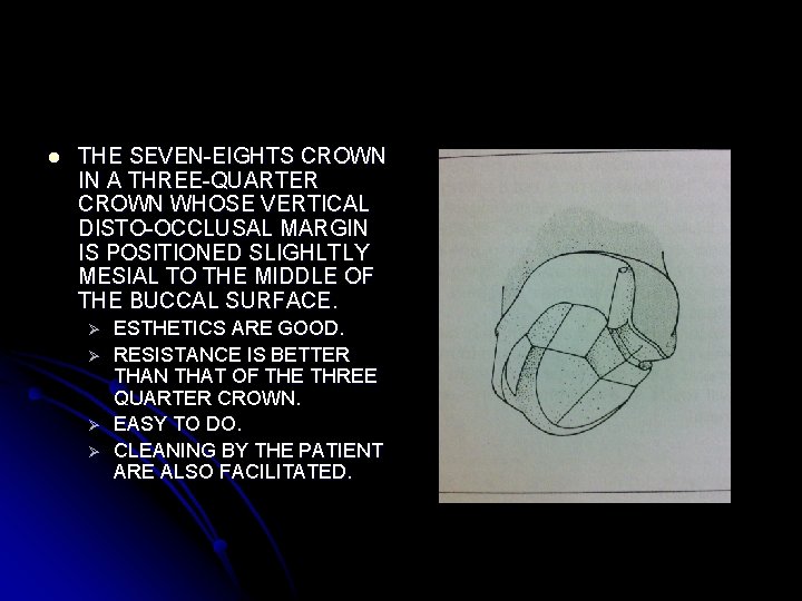 l THE SEVEN-EIGHTS CROWN IN A THREE-QUARTER CROWN WHOSE VERTICAL DISTO-OCCLUSAL MARGIN IS POSITIONED