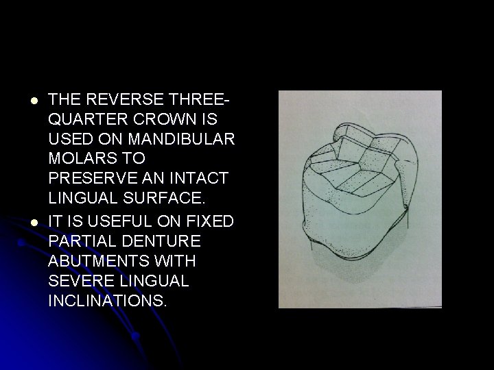 l l THE REVERSE THREEQUARTER CROWN IS USED ON MANDIBULAR MOLARS TO PRESERVE AN