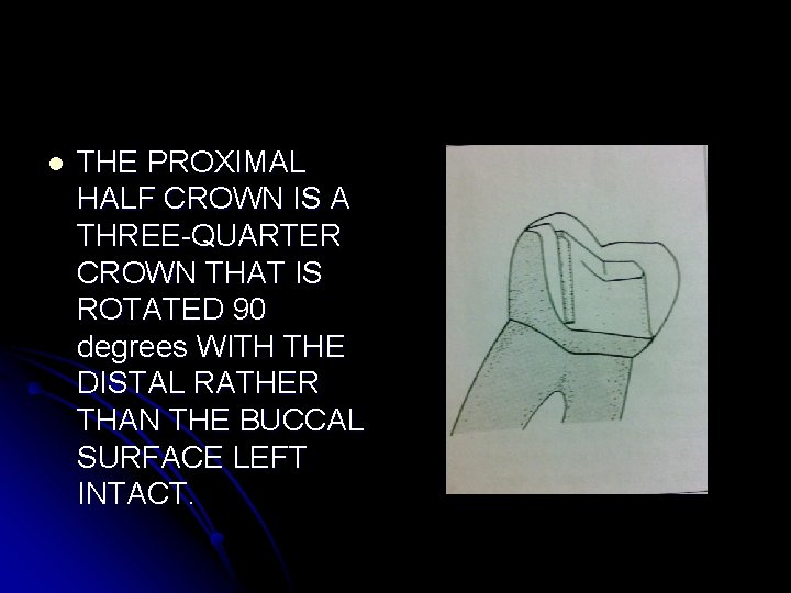 l THE PROXIMAL HALF CROWN IS A THREE-QUARTER CROWN THAT IS ROTATED 90 degrees