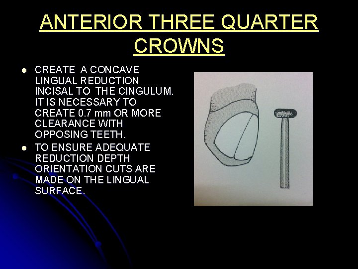 ANTERIOR THREE QUARTER CROWNS l l CREATE A CONCAVE LINGUAL REDUCTION INCISAL TO THE
