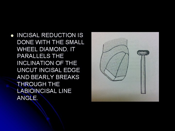 l INCISAL REDUCTION IS DONE WITH THE SMALL WHEEL DIAMOND. IT PARALLELS THE INCLINATION