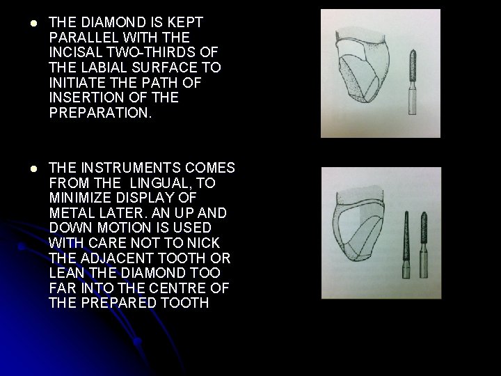 l THE DIAMOND IS KEPT PARALLEL WITH THE INCISAL TWO-THIRDS OF THE LABIAL SURFACE