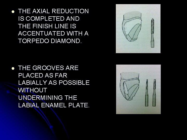 l THE AXIAL REDUCTION IS COMPLETED AND THE FINISH LINE IS ACCENTUATED WITH A