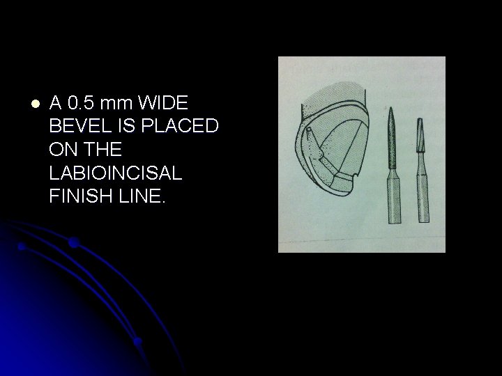 l A 0. 5 mm WIDE BEVEL IS PLACED ON THE LABIOINCISAL FINISH LINE.