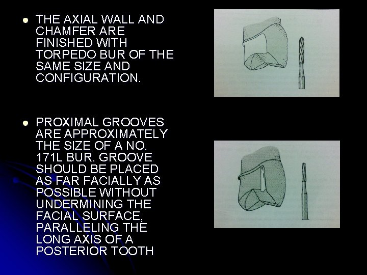 l THE AXIAL WALL AND CHAMFER ARE FINISHED WITH TORPEDO BUR OF THE SAME