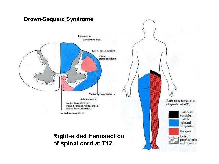 Brown-Sequard Syndrome Right-sided Hemisection of spinal cord at T 12. 