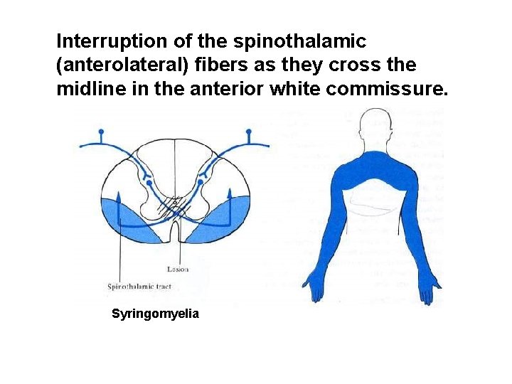 Interruption of the spinothalamic (anterolateral) fibers as they cross the midline in the anterior