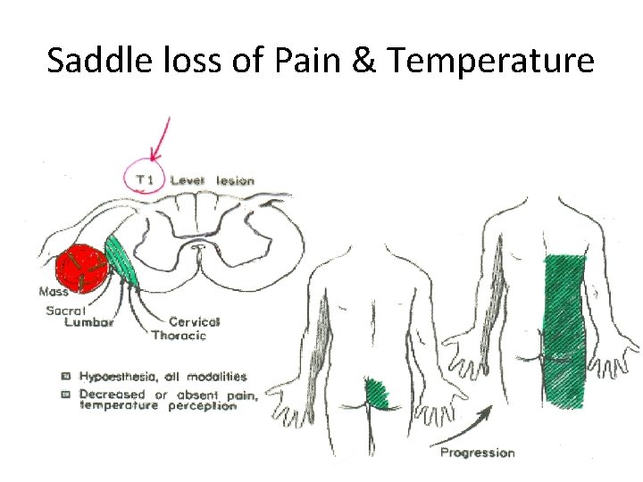 Saddle loss of Pain & Temperature 