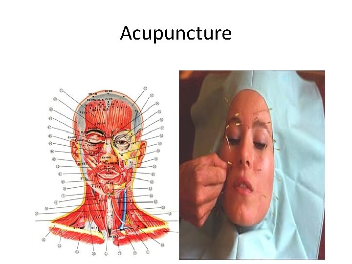 Acupuncture 