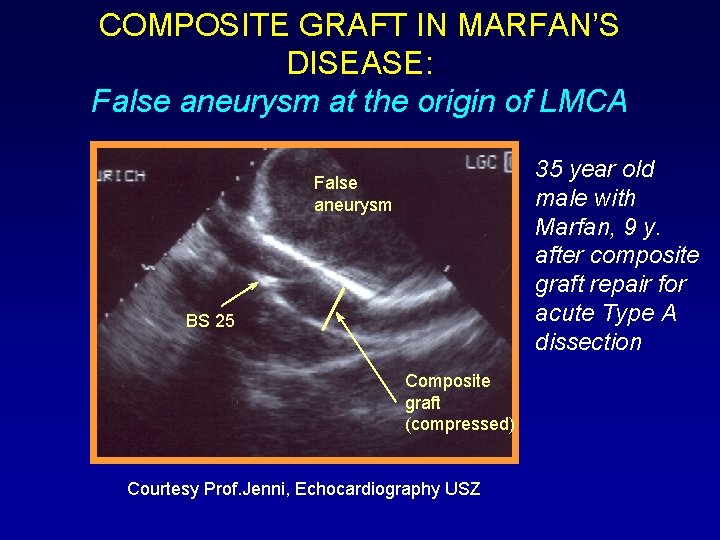 COMPOSITE GRAFT IN MARFAN’S DISEASE: False aneurysm at the origin of LMCA BS 25