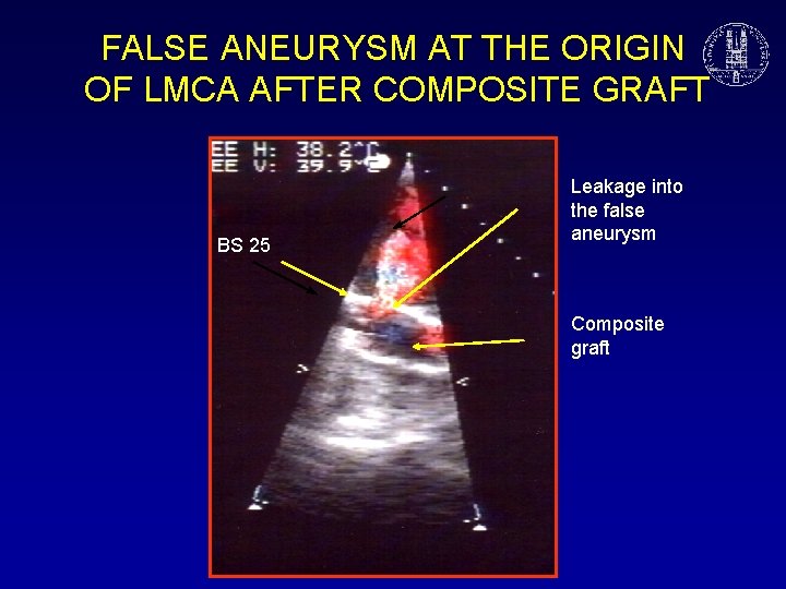FALSE ANEURYSM AT THE ORIGIN OF LMCA AFTER COMPOSITE GRAFT LA BS 25 Aortic