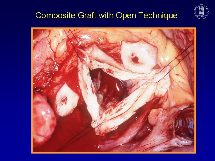 Composite Graft with Open Technique 