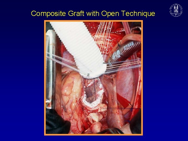 Composite Graft with Open Technique 
