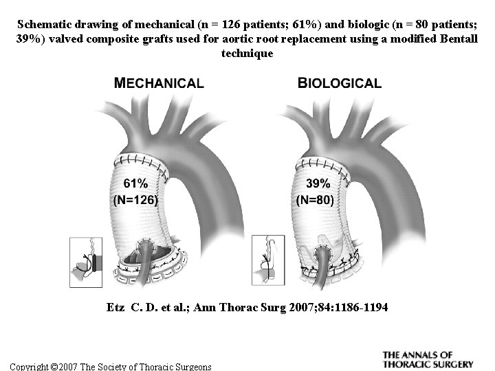Schematic drawing of mechanical (n = 126 patients; 61%) and biologic (n = 80