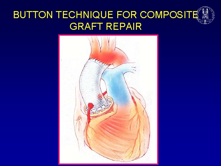 BUTTON TECHNIQUE FOR COMPOSITE GRAFT REPAIR 
