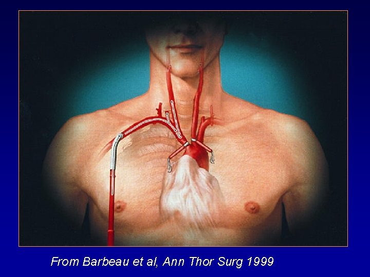 From Barbeau et al, Ann Thor Surg 1999 