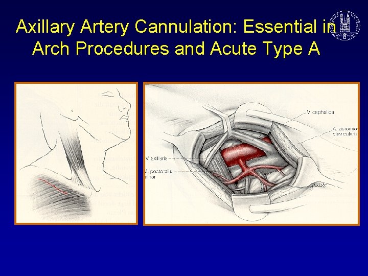 Axillary Artery Cannulation: Essential in Arch Procedures and Acute Type A 