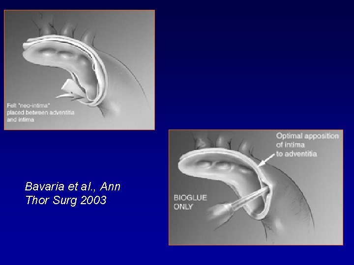 Bavaria et al. , Ann Thor Surg 2003 