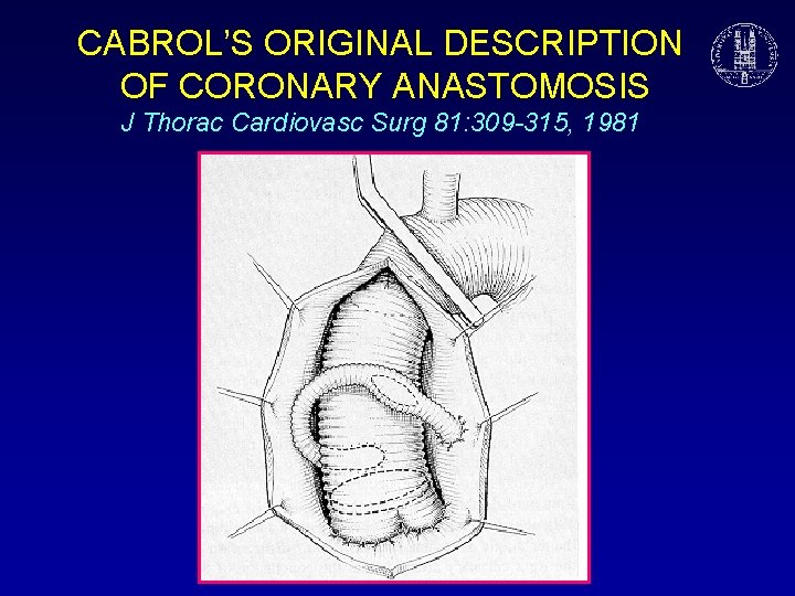CABROL’S ORIGINAL DESCRIPTION OF CORONARY ANASTOMOSIS J Thorac Cardiovasc Surg 81: 309 -315, 1981