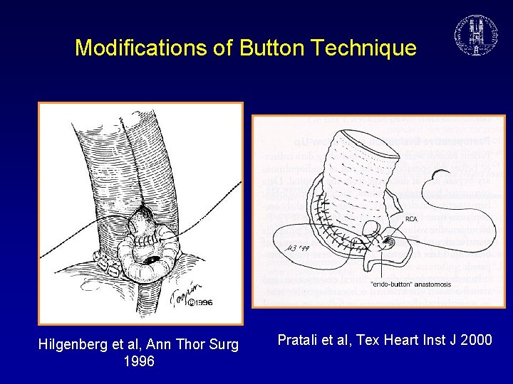 Modifications of Button Technique Hilgenberg et al, Ann Thor Surg 1996 Pratali et al,