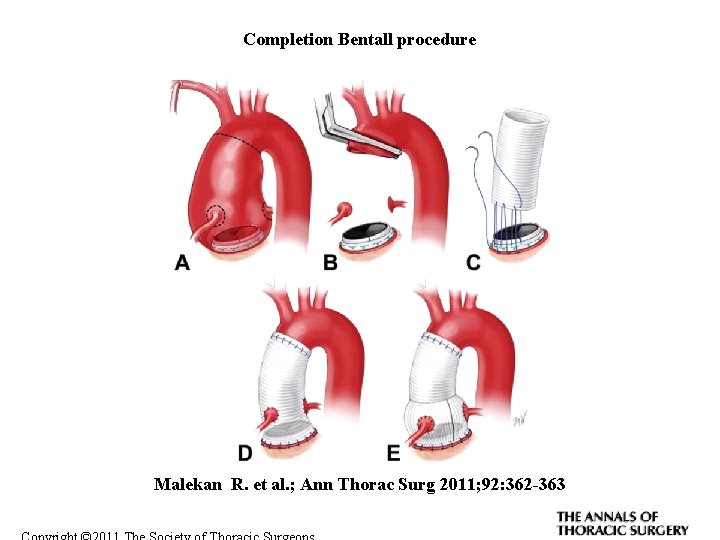 Completion Bentall procedure Malekan R. et al. ; Ann Thorac Surg 2011; 92: 362