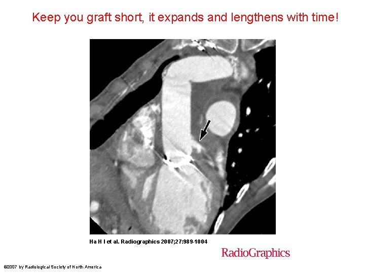 Keep you graft short, it expands and lengthens with time! Ha H I et