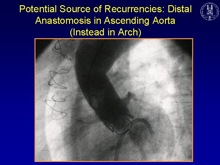 Potential Source of Recurrencies: Distal Anastomosis in Ascending Aorta (Instead in Arch) 