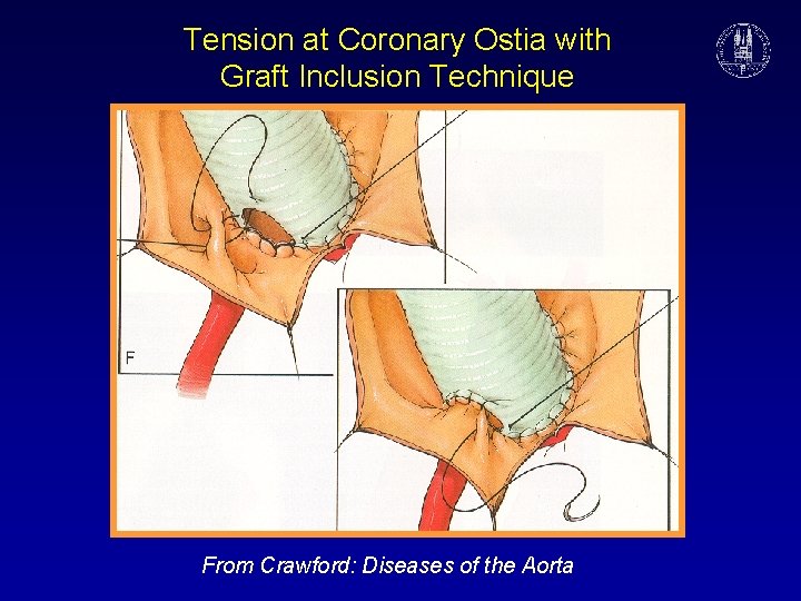 Tension at Coronary Ostia with Graft Inclusion Technique From Crawford: Diseases of the Aorta