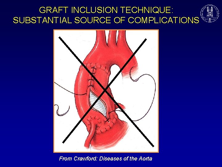 GRAFT INCLUSION TECHNIQUE: SUBSTANTIAL SOURCE OF COMPLICATIONS From Crawford: Diseases of the Aorta 
