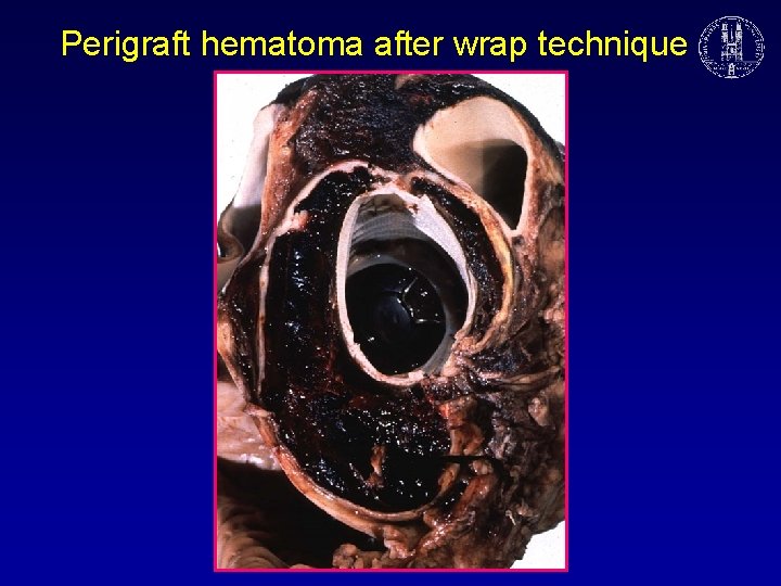 Perigraft hematoma after wrap technique 