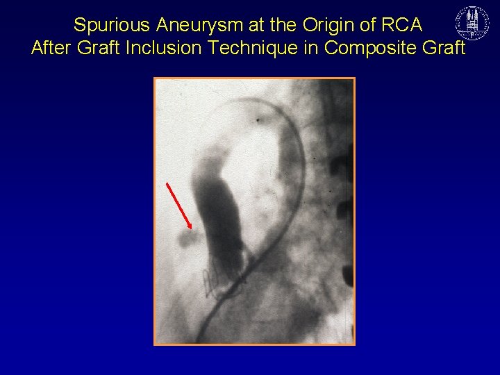 Spurious Aneurysm at the Origin of RCA After Graft Inclusion Technique in Composite Graft