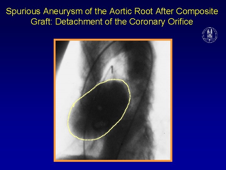 Spurious Aneurysm of the Aortic Root After Composite Graft: Detachment of the Coronary Orifice